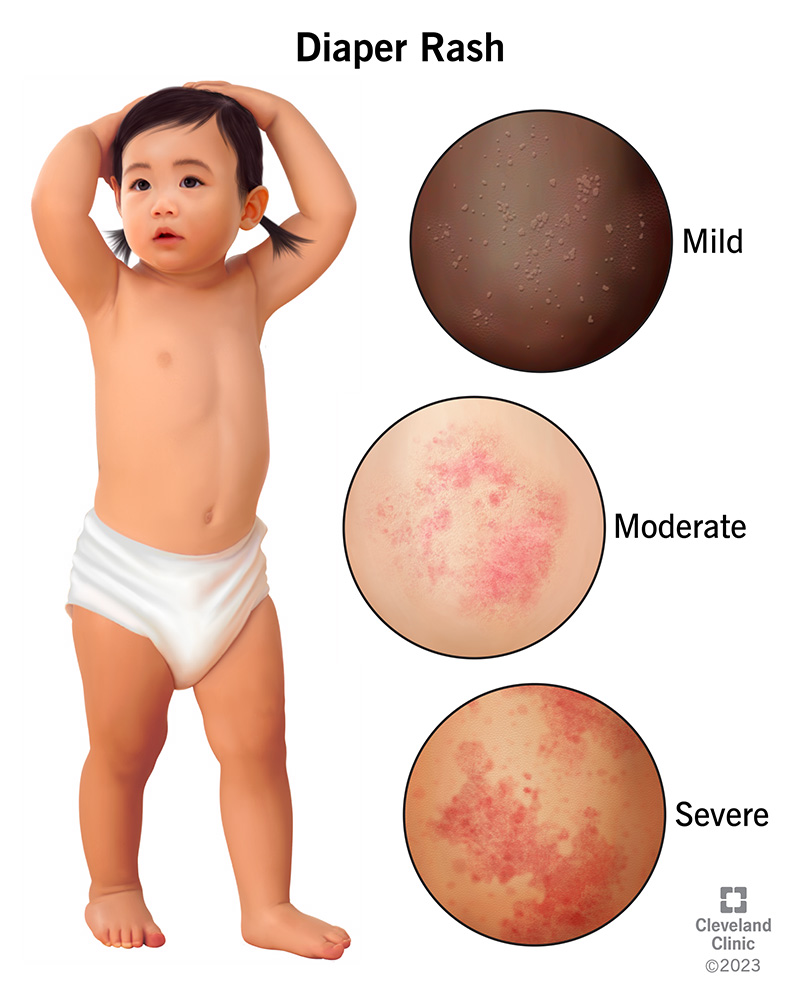 Baby Diaper Rash Vs Yeast Infection