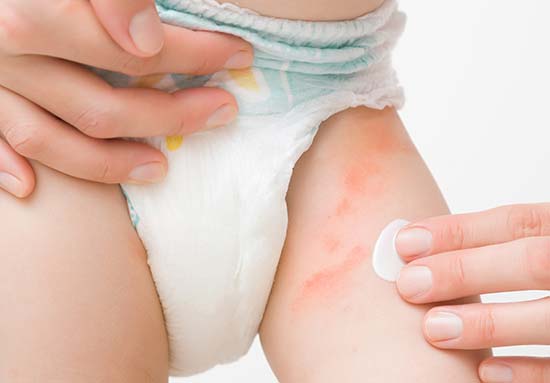 What to Do If Baby Has Nappy Rash