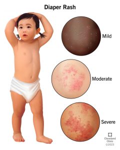 Why Baby Has Diaper Rash