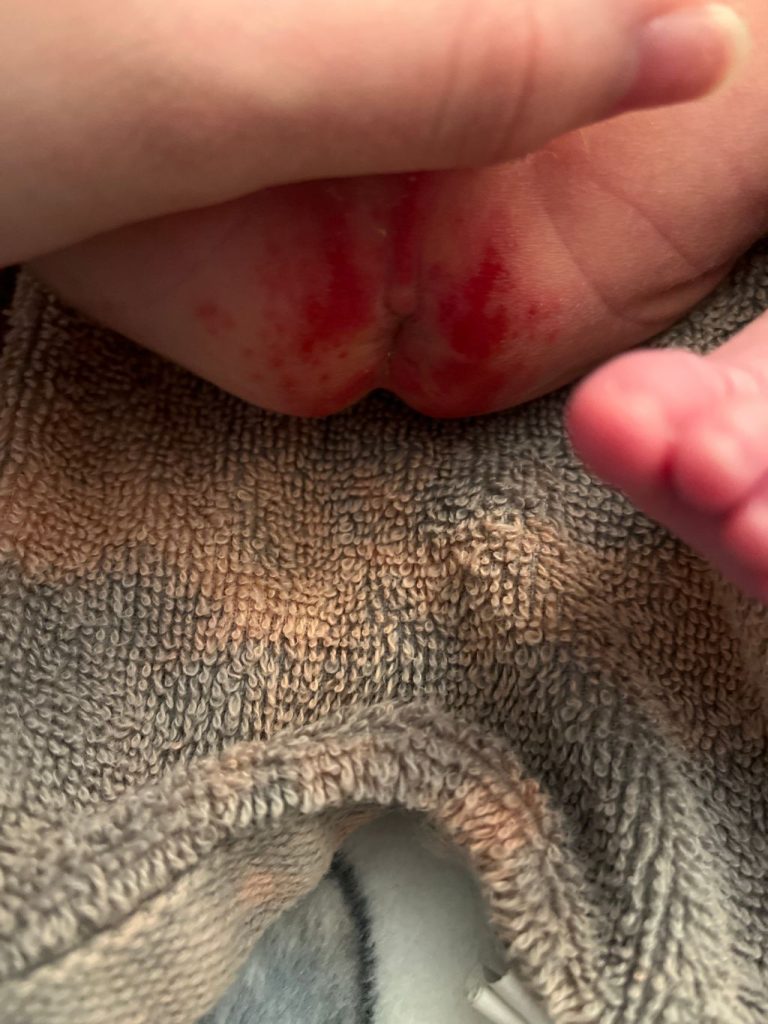 Why is My Baby'S Diaper Rash Bleeding