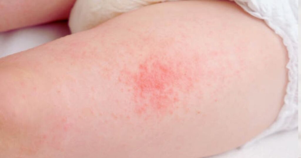 How to Help Baby Diaper Rash How to Help Baby Diaper Rash