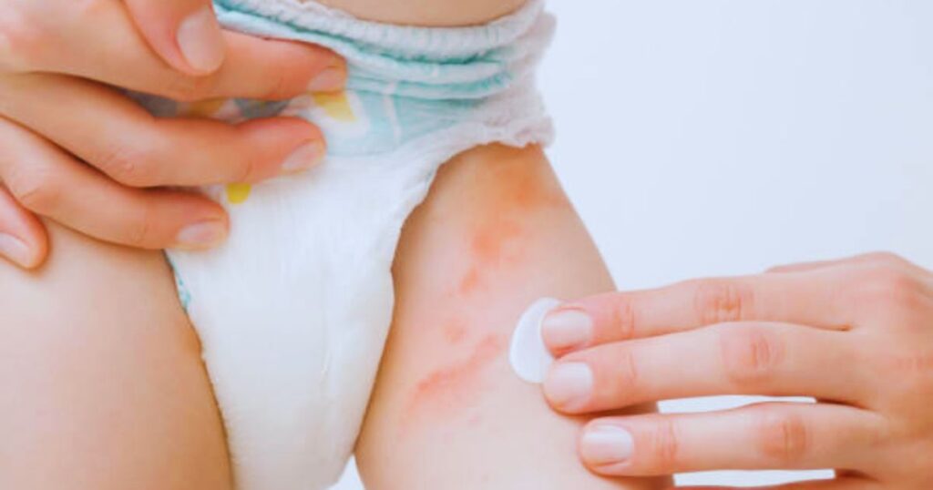 How to Use Baby Diaper Rash Cream